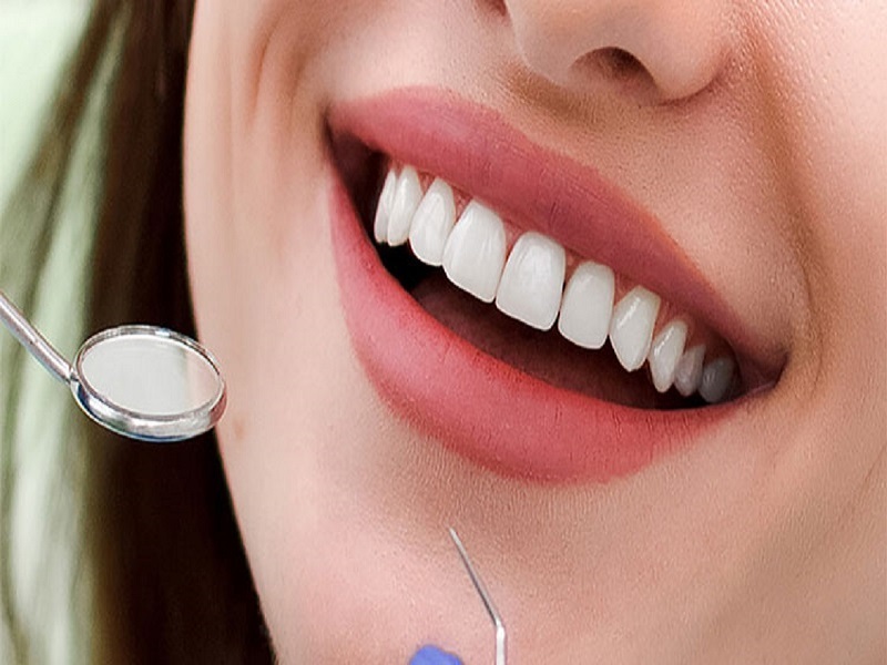 لمینت دندان: راهی آسان و موثر برای بهبود ظاهر لبخند شما