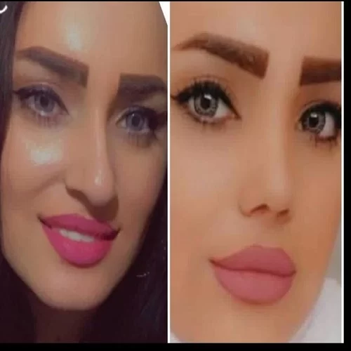 نمونه جراحی بینی دکتر خسرو خسروی 1