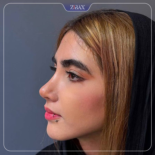 نمونه عمل جراحی بینی دکتر حمید نوری — تصویر 10