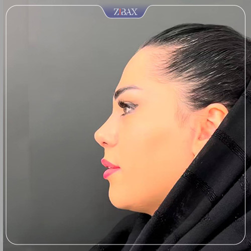 نتیجه جراحی