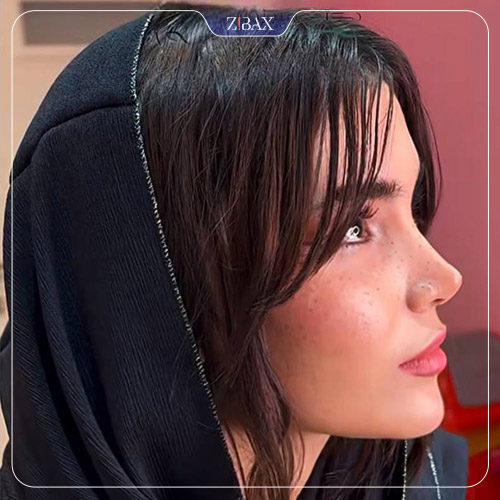 نمونه عمل جراحی بینی دکتر حمید نوری — تصویر 6