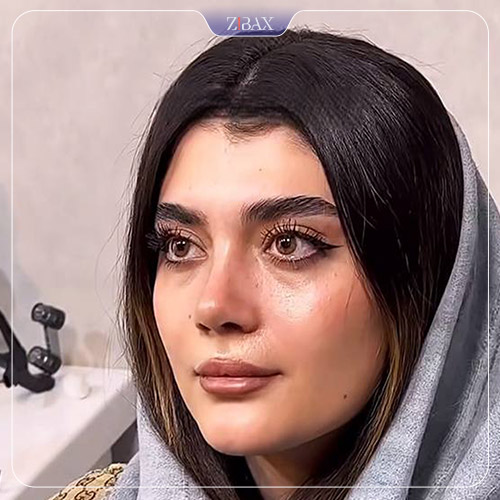نمونه عمل جراحی بینی دکتر رویا لطفی یگانه — تصویر 6