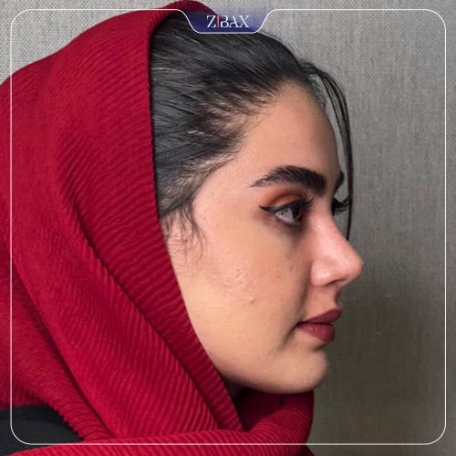نمونه عمل جراحی بینی دکتر رویا لطفی یگانه — تصویر 8