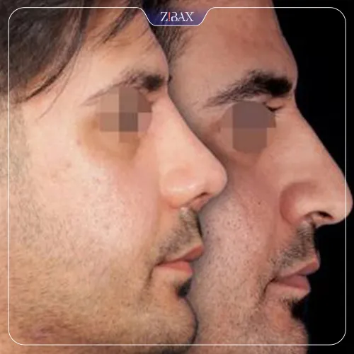 نمونه عمل جراحی بینی دکتر محسن روشنی — تصویر 5