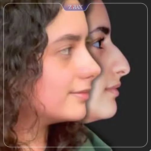 نمونه عمل جراحی بینی دکتر محسن روشنی — تصویر 7