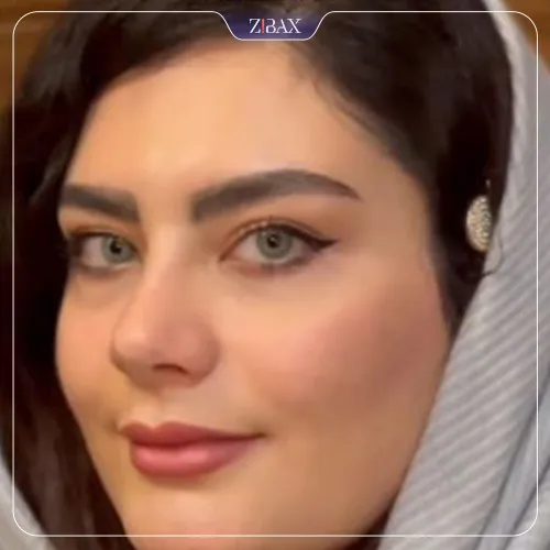 نمونه عمل جراحی بینی دکتر محسن روشنی — تصویر 4