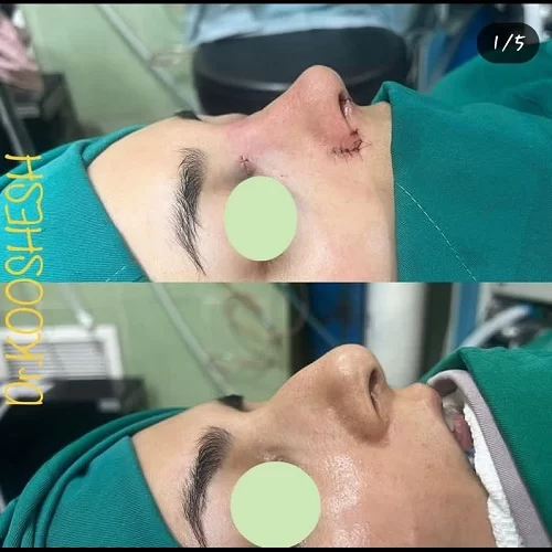 نمونه کار دکتر محمد اسماعیل کوشش جراح بینی شیراز