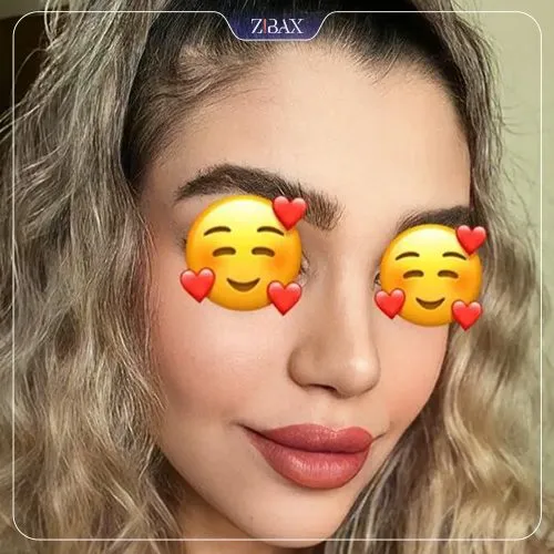 نمونه عمل جراحی بینی دکتر غلامرضا معین — تصویر 7