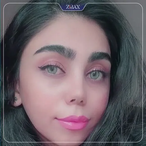 نمونه عمل جراحی بینی دکتر غلامرضا معین — تصویر 2