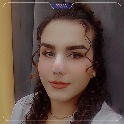 نمونه عمل جراحی بینی دکتر غلامرضا معین — تصویر 5