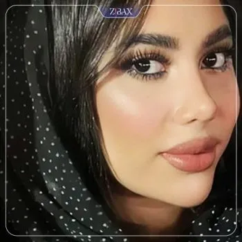 نمونه عمل جراحی بینی دکتر لیلا اسدپور — تصویر 6