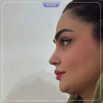 نمونه عمل جراحی بینی دکتر لیلا اسدپور — تصویر 9