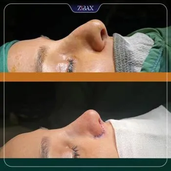 نمونه عمل جراحی بینی دکتر بهروز گندمی — تصویر 6