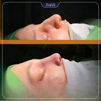 نمونه عمل جراحی بینی دکتر بهروز گندمی — تصویر 7