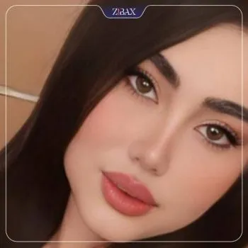 نمونه عمل جراحی بینی دکتر بهروز گندمی — تصویر 5