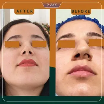 نمونه عمل جراحی بینی دکتر بهروز گندمی — تصویر 4
