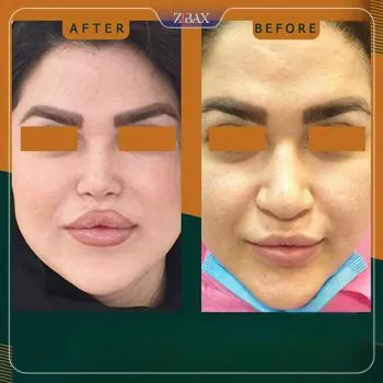 نمونه عمل جراحی بینی دکتر بهروز گندمی — تصویر 9