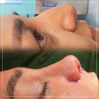 نمونه عمل جراحی بینی دکتر بهروز گندمی — تصویر 10