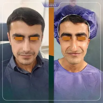 نتیجه جراحی