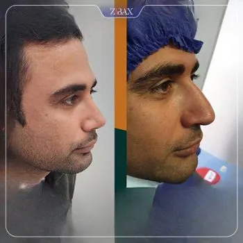 نتیجه جراحی
