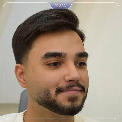نمونه عمل جراحی بینی دکتر حامد پوستچی — تصویر 7