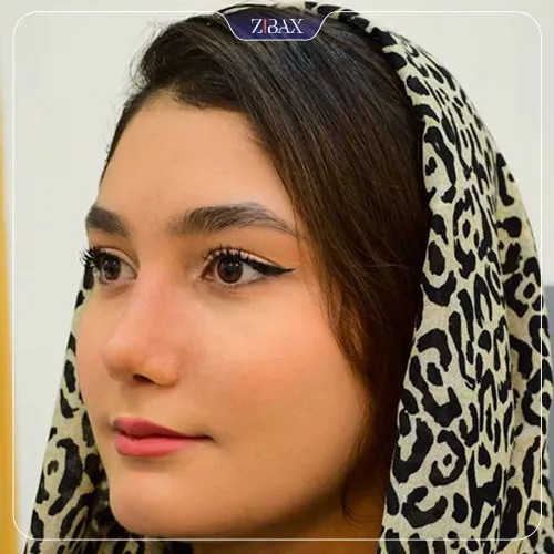 نمونه عمل جراحی بینی دکتر حامد پوستچی — تصویر 6
