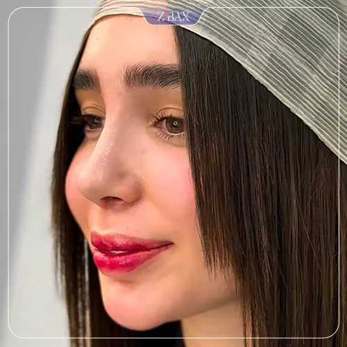 نمونه عمل جراحی بینی دکتر حامد پوستچی — تصویر 5
