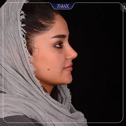 نتیجه جراحی