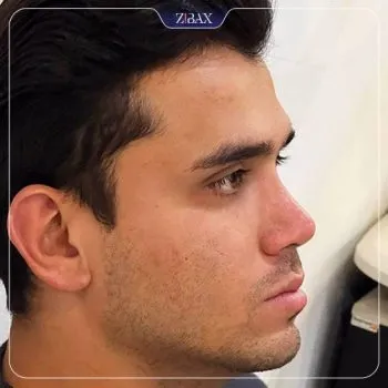 نمونه عمل جراحی بینی دکتر شهریار شاهمرادی — تصویر 5