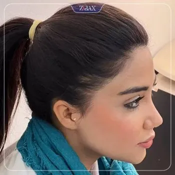نمونه عمل جراحی بینی دکتر شهریار شاهمرادی — تصویر 7