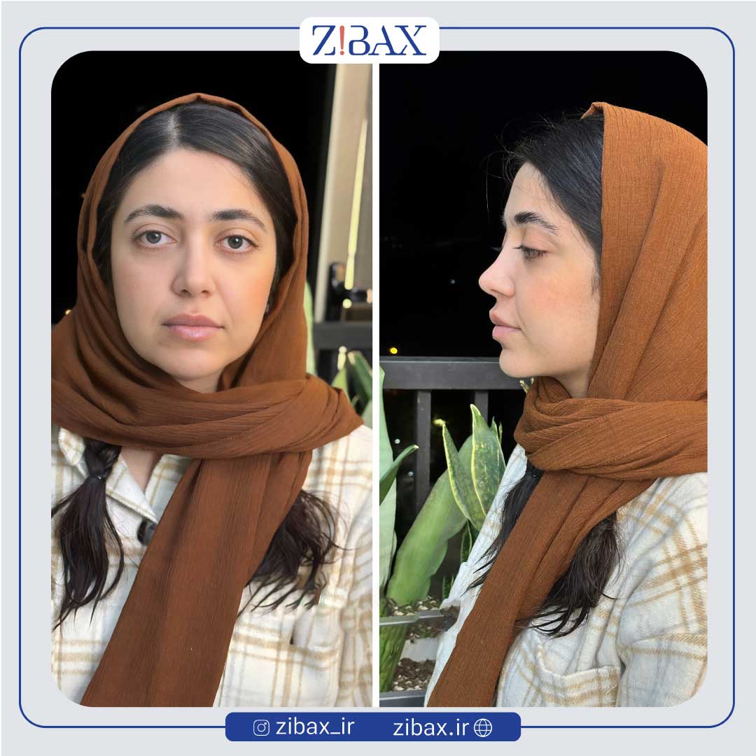 نمونه عمل جراحی بینی دکتر مسیح طالع جراح بینی شیراز — تصویر 7