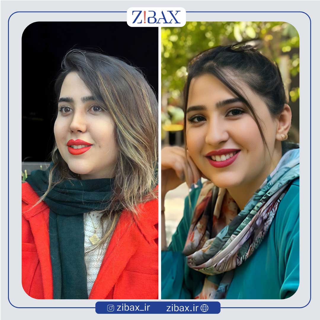 نمونه عمل جراحی بینی دکتر مسیح طالع جراح بینی شیراز — تصویر 6