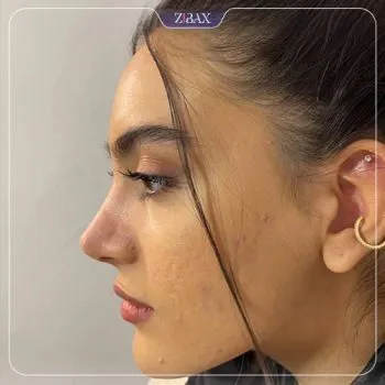 نمونه عمل جراحی بینی دکتر آرش سبحان منش — تصویر 8