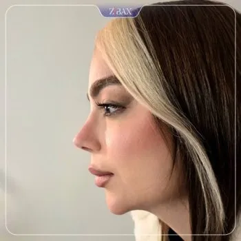 نمونه عمل جراحی بینی دکتر آرش سبحان منش — تصویر 2