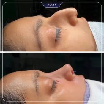 نمونه عمل جراحی بینی دکتر آرش سبحان منش — تصویر 5