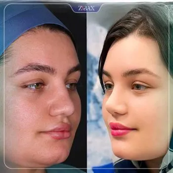 نمونه عمل جراحی بینی دکتر سلمان شاکری — تصویر 7