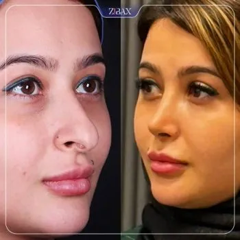 نمونه عمل جراحی بینی دکتر سلمان شاکری — تصویر 6