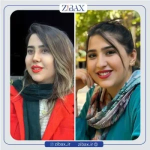 نمونه عمل بینی گوشتی دکتر مسیح طالع جراح بینی شیراز