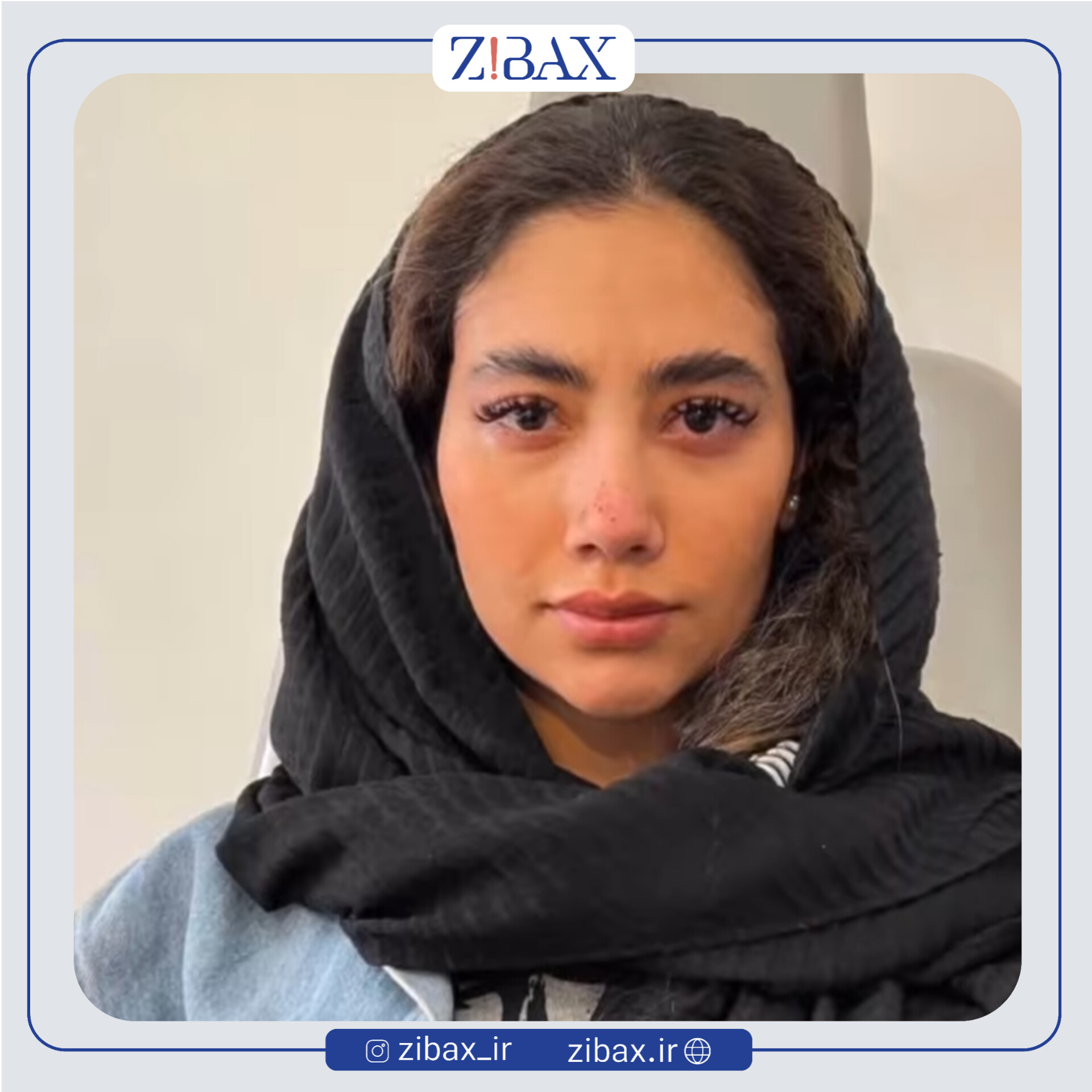 نمونه عمل جراحی بینی دکتر حامد محمدی — تصویر 2