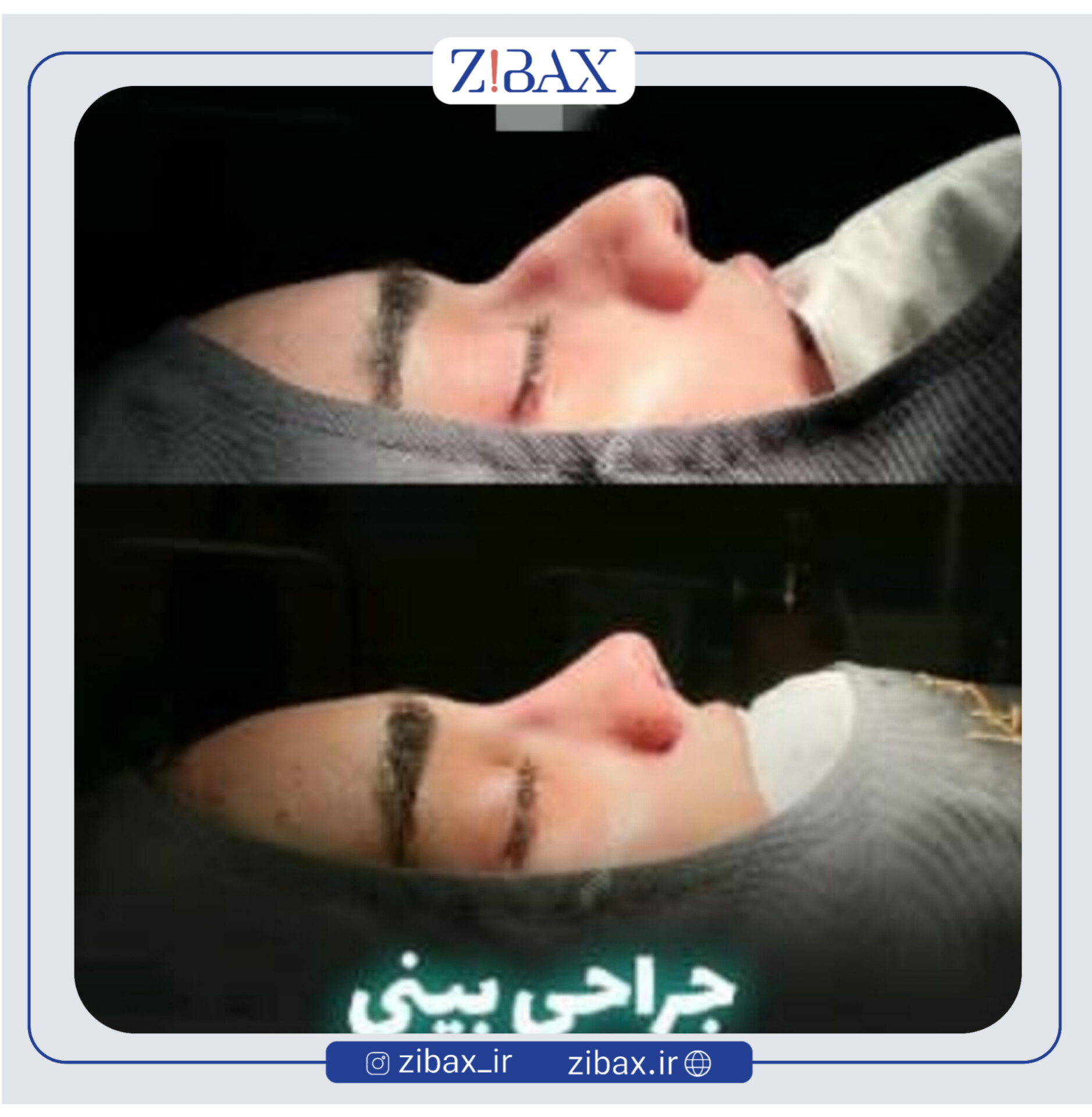نمونه عمل جراحی بینی دکتر حامد محمدی — تصویر 8