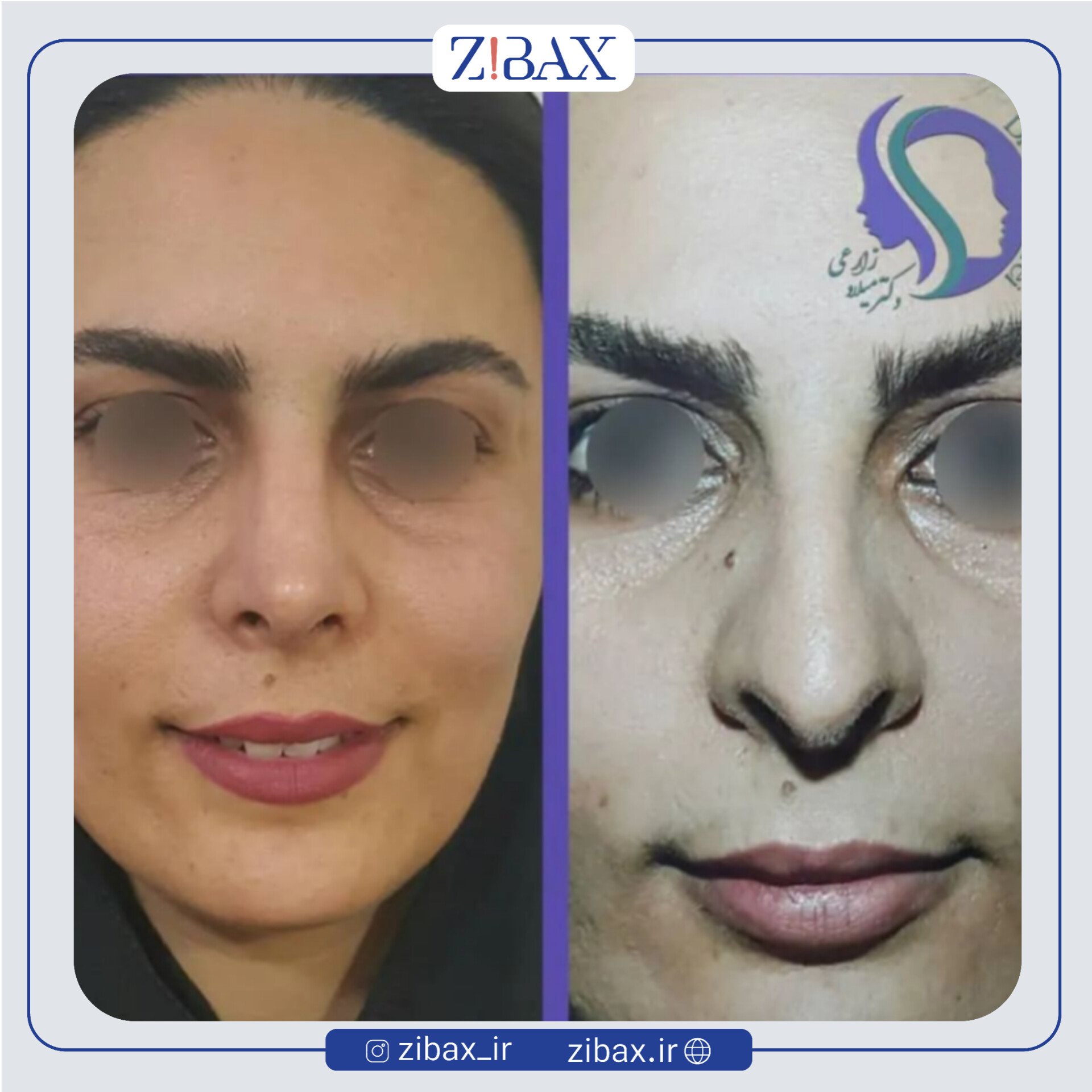 نمونه عمل جراحی بینی دکتر میلاد زارعی — تصویر 1