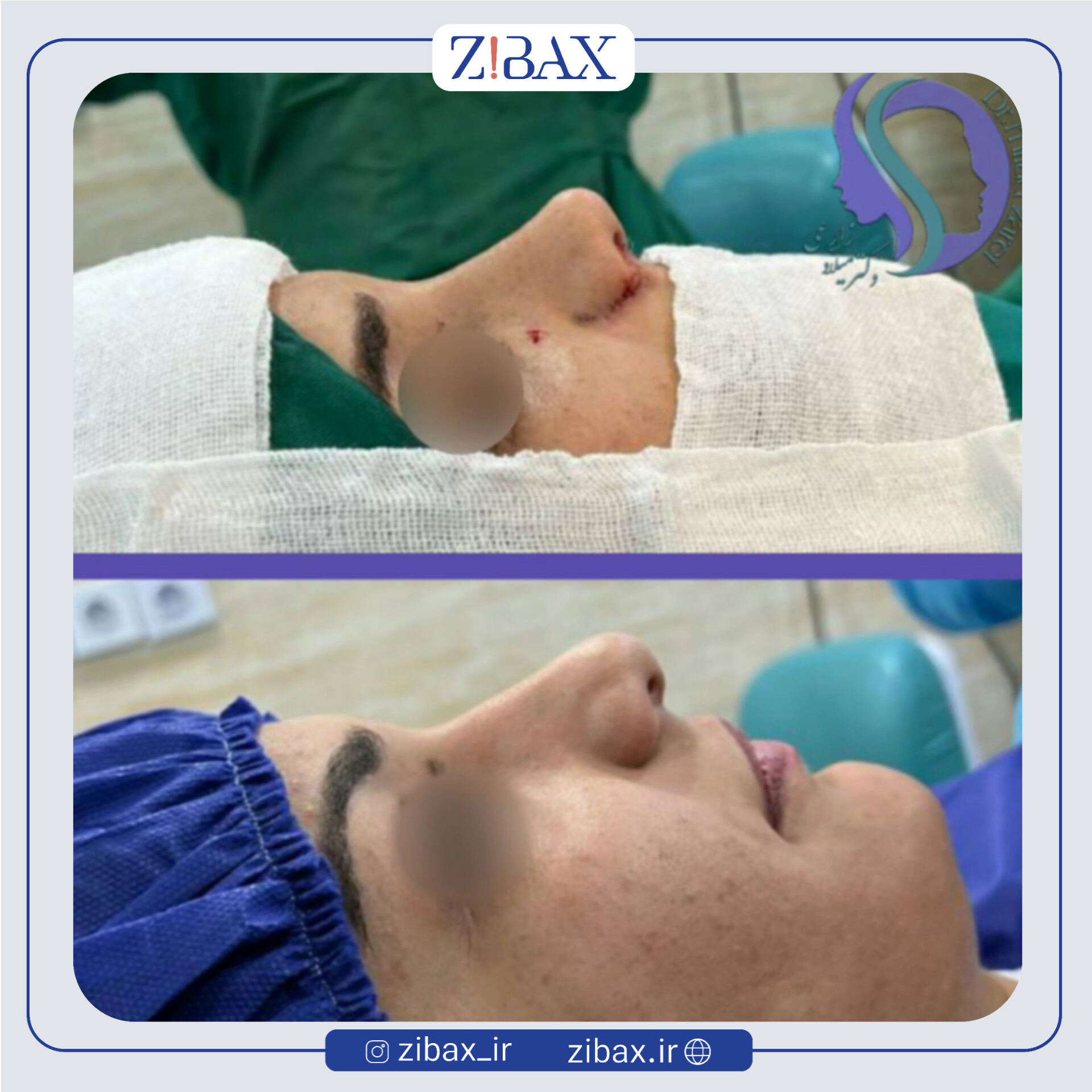 نمونه عمل جراحی بینی دکتر میلاد زارعی — تصویر 2