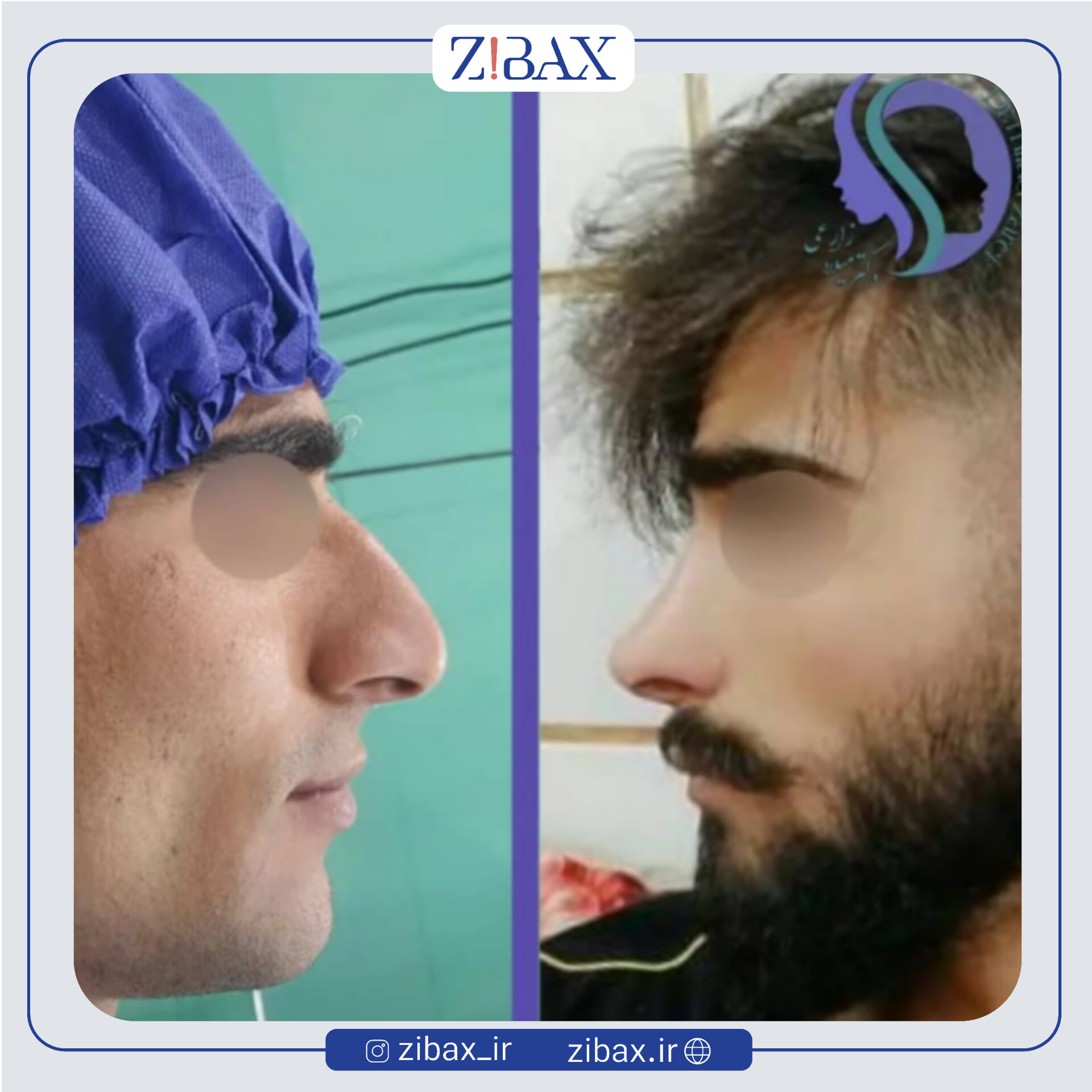 نمونه عمل جراحی بینی دکتر میلاد زارعی — تصویر 4