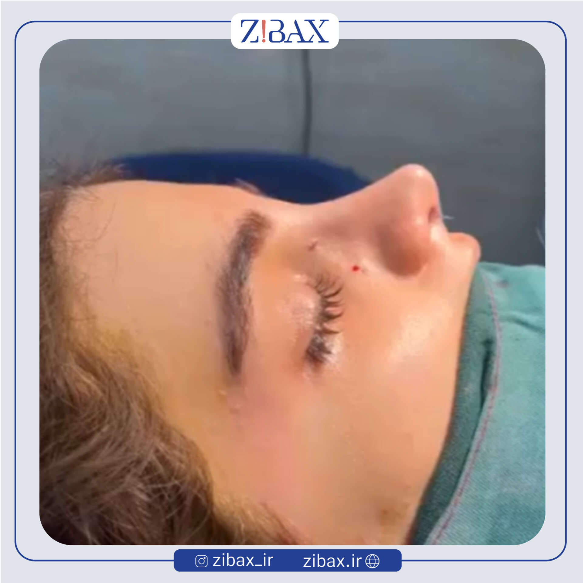 نمونه عمل جراحی بینی دکتر میلاد زارعی — تصویر 5