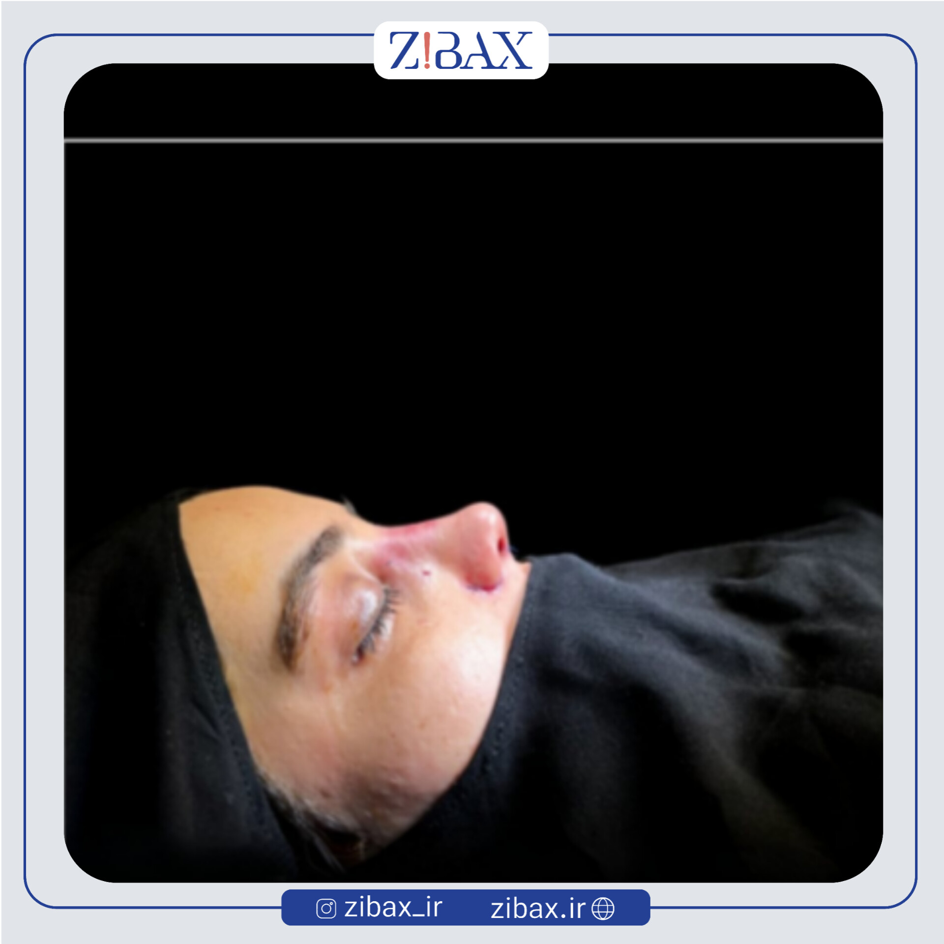 نمونه عمل جراحی بینی دکتر میلاد زارعی — تصویر 6
