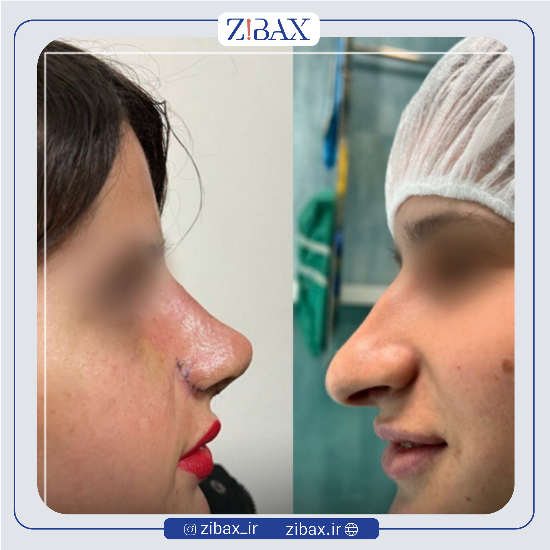 نمونه عمل جراحی بینی دکتر میلاد زارعی — تصویر 7