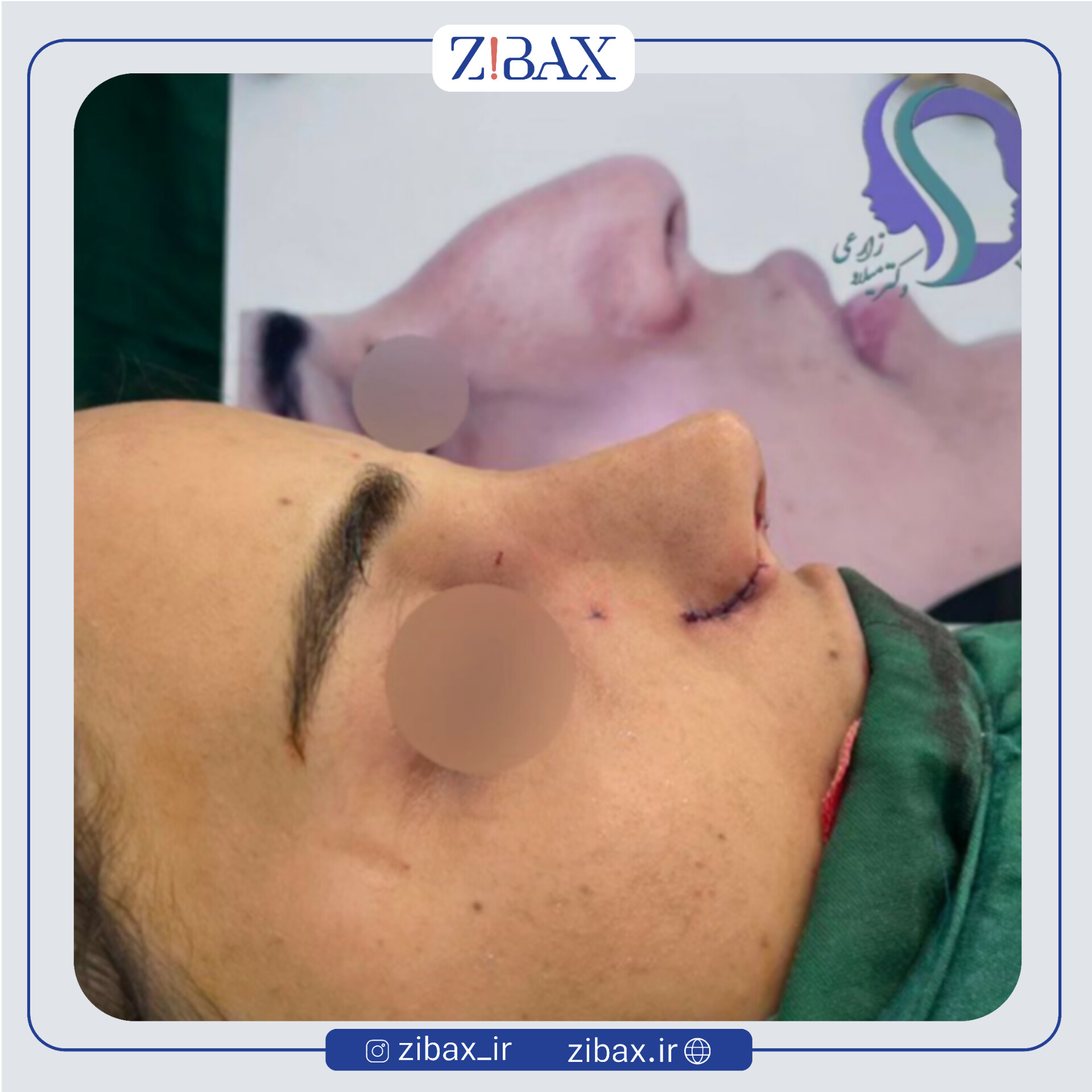نمونه عمل جراحی بینی دکتر میلاد زارعی — تصویر 8