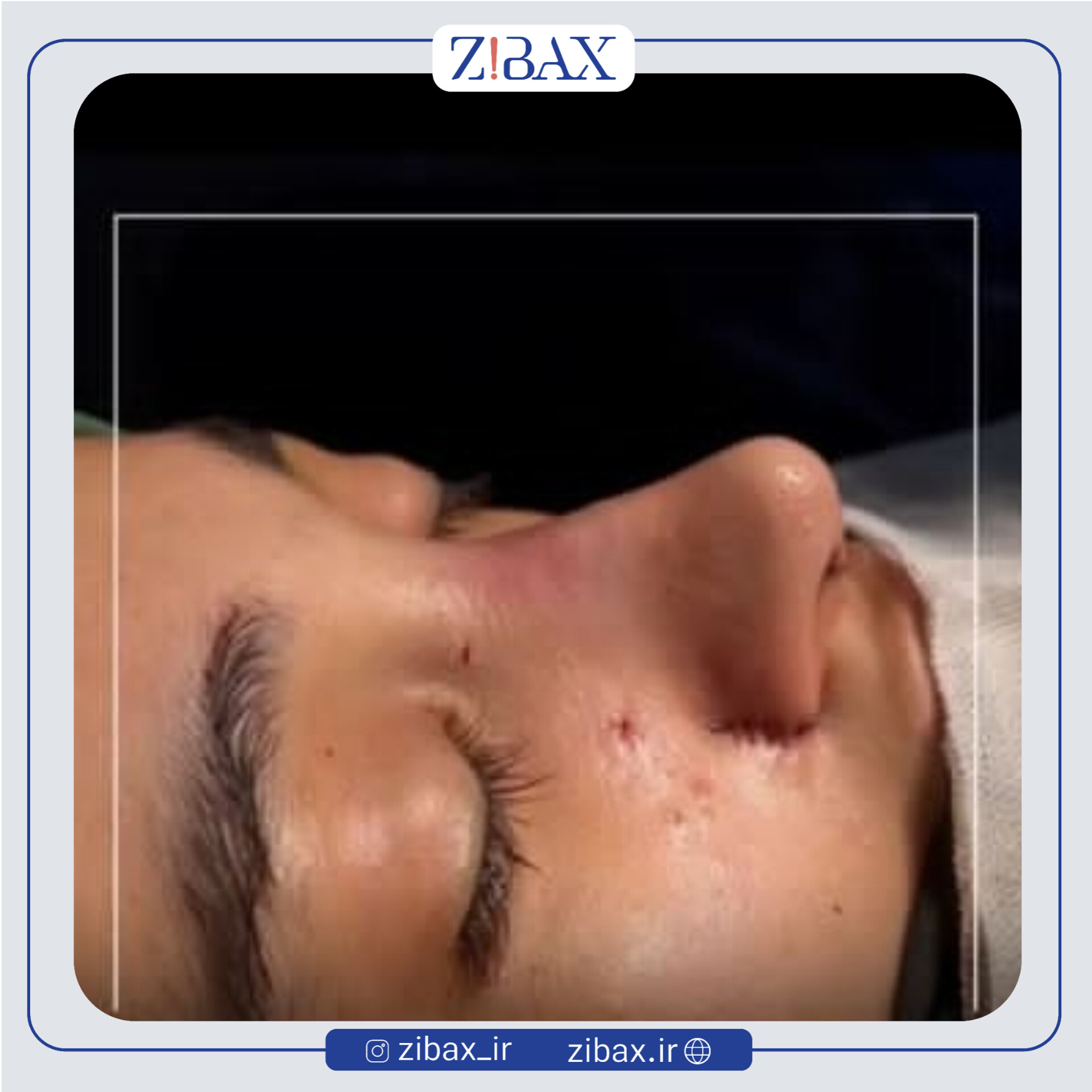 نمونه عمل جراحی بینی دکتر میلاد زارعی — تصویر 9