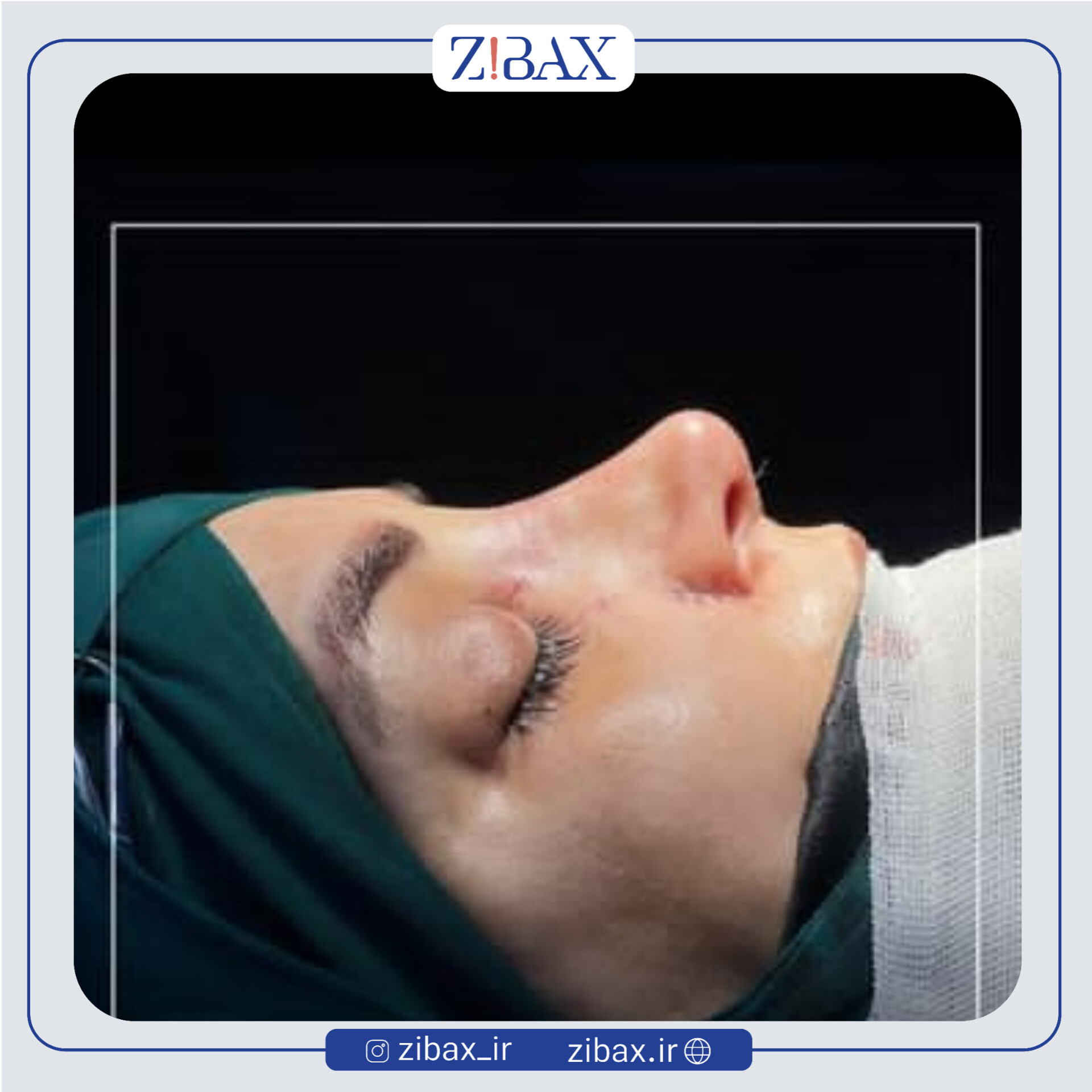 نمونه عمل جراحی بینی دکتر میلاد زارعی — تصویر 10