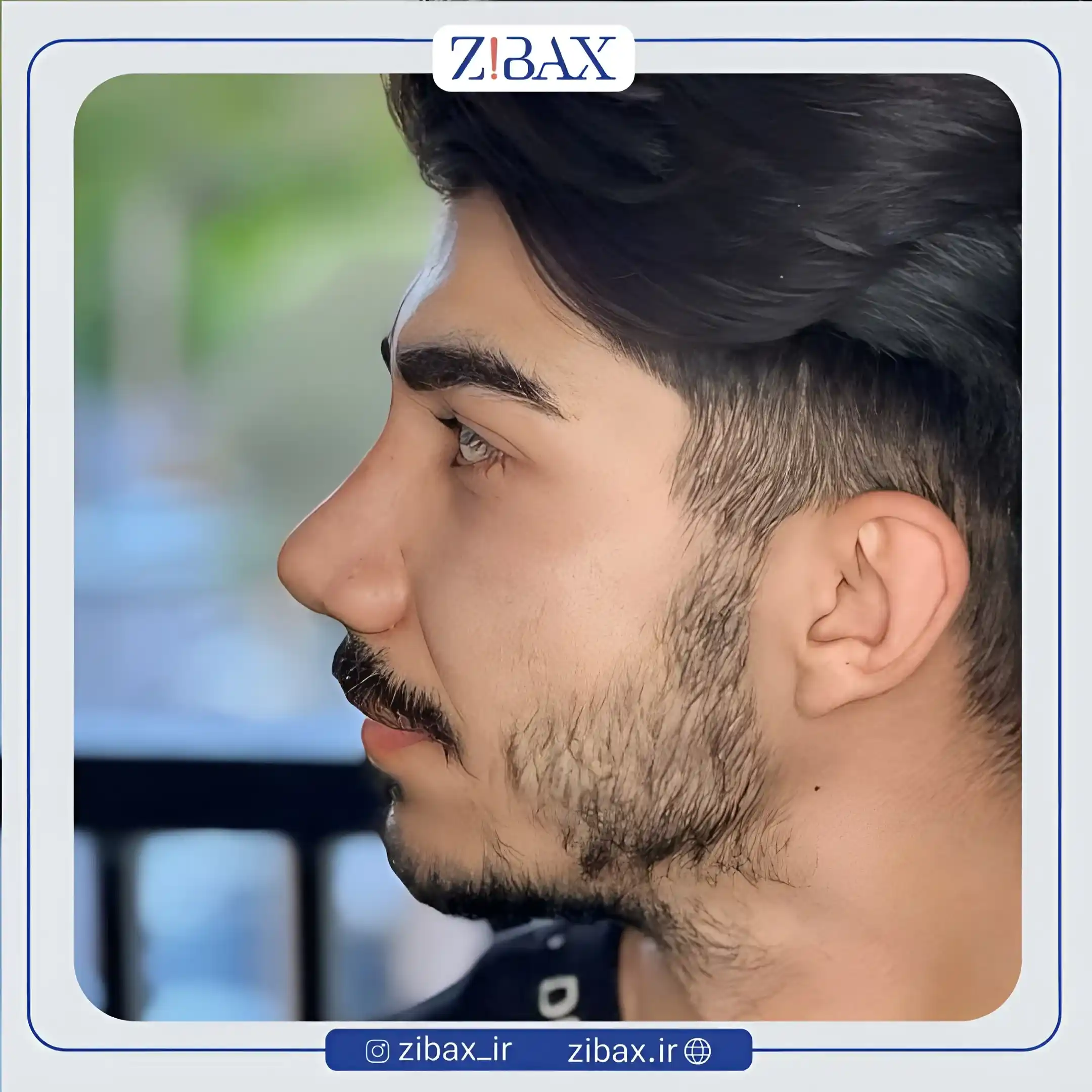 نمونه عمل جراحی بینی دکتر محسن بهادر — تصویر 3